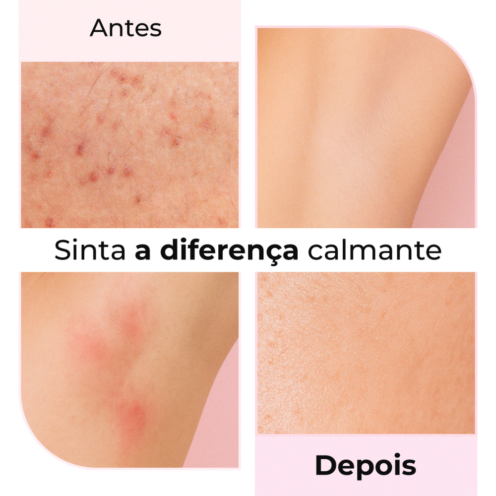 Resultados antes e depois do uso do óleo pós-barba Silky Balloon da Lumisilk, com melhora visível da vermelhidão e da textura da pele.