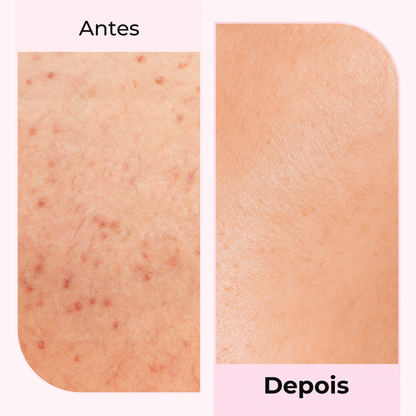 Imagem antes e depois do uso do óleo pós-barba Silky Balloon da Lumisilk, com redução de vermelhidão e pele visivelmente mais suave.